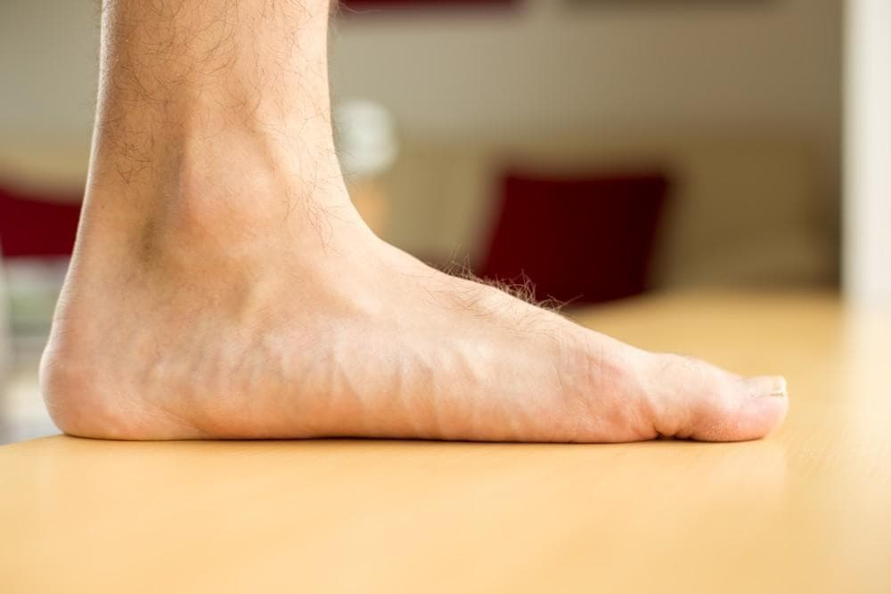 A child's foot from the side, its inner arch collapsed flat against the floor.
