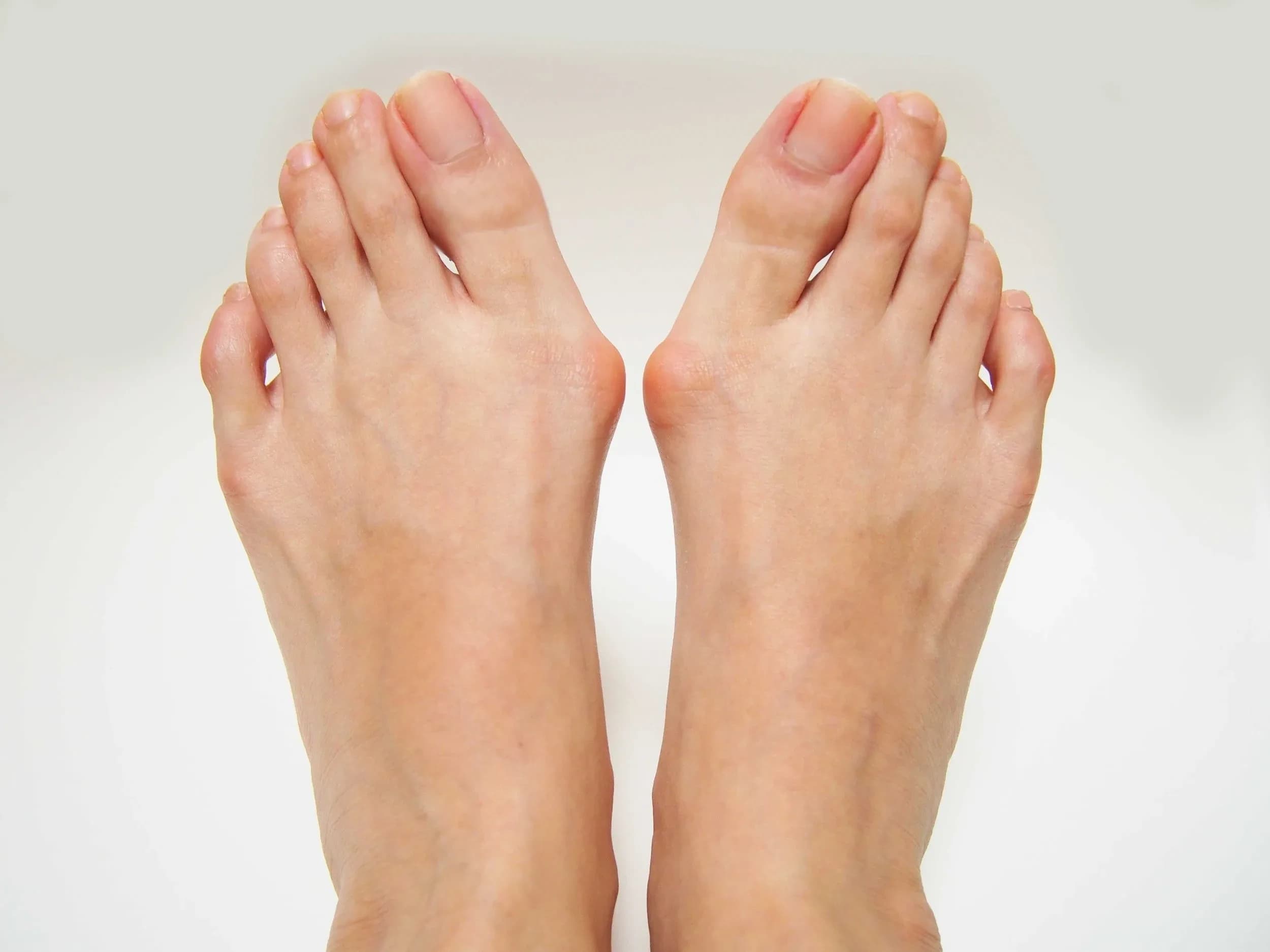 An adult's feet years later, with a pronounced bony bump at the base of each big toe and the toe angled in toward the others.